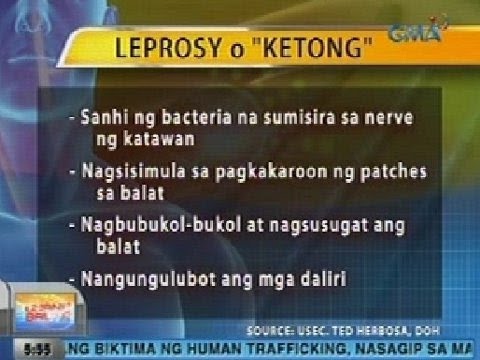 Paggamot ng kuko halamang-singaw clotrimazole ointment Gamutin para sa mga halamang-singaw sa kanyang mga paa