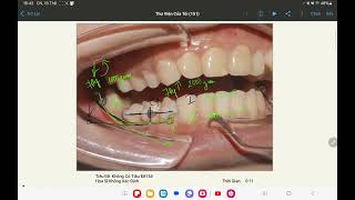Dựng trục R7 dưới - Phần 2