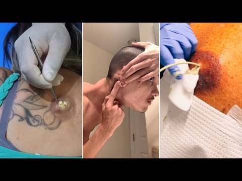 Satisfying Pimple Popping And Cyst Removal | Pimples Removal | Pimple Explosion | Pimple Popper