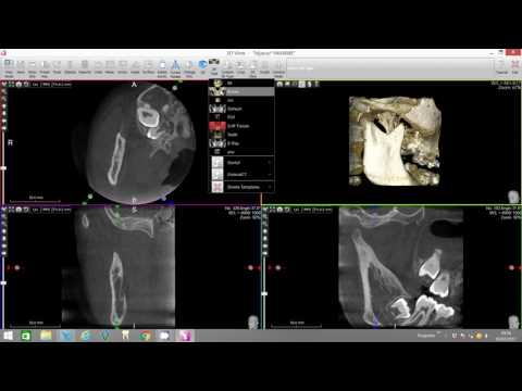 X-Mind Trium 3rd molar virtual endoscope