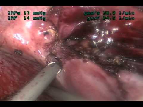 Minimally Invasive Removal Of The Rudimentary Horn Of the Uterus