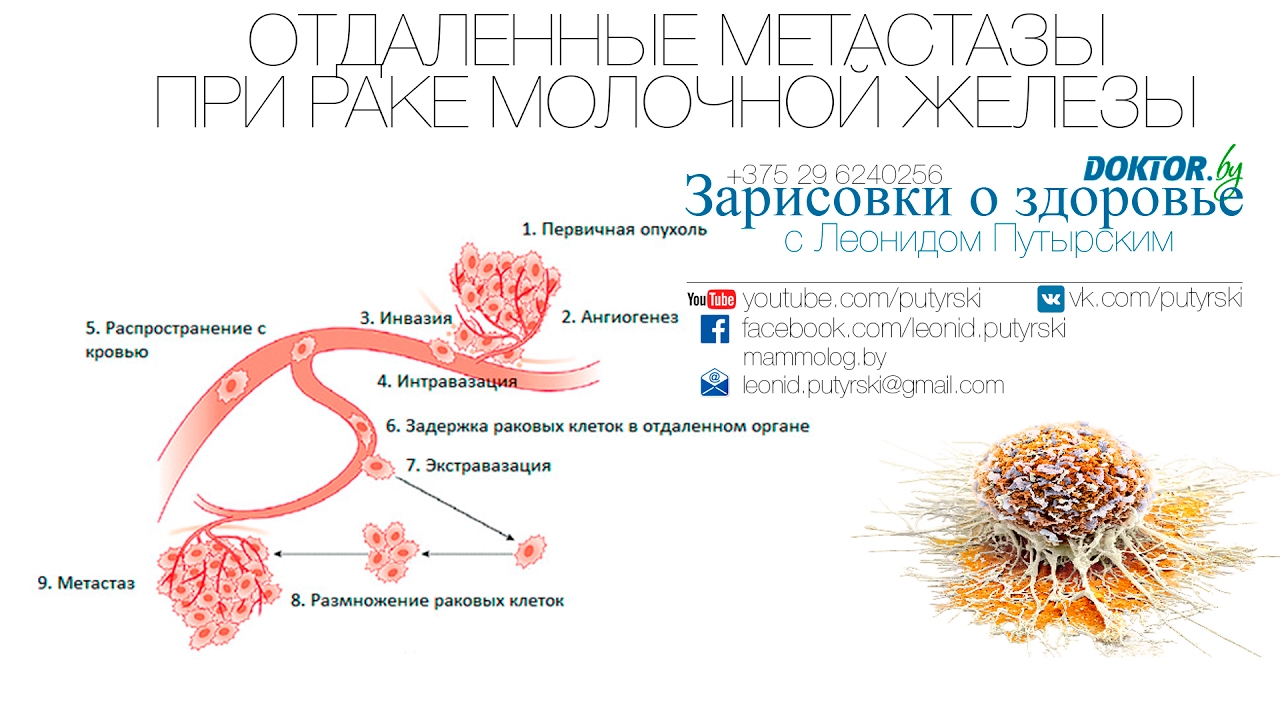 Отдаленные метастазы при раке молочной железы. Зарисовки о здоровье с Леонидом Путырским. Выпуск 20.