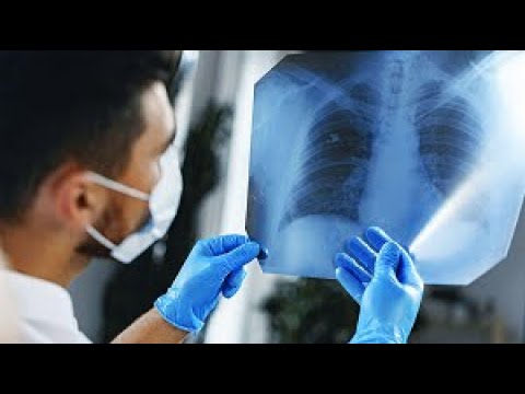 Để phát hiện sớm ung thư phổi