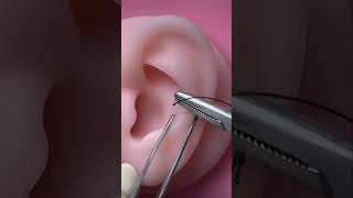 Download lagu Ear reconstruction after cancer excision mp3