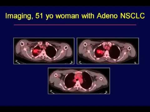 GRACEcast-066_Lung-Cancer_Expert Round Table - NSCLC Molecular Markers Case 2