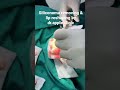 Siliconoma Removing Lip Reshapig By Dr Apple