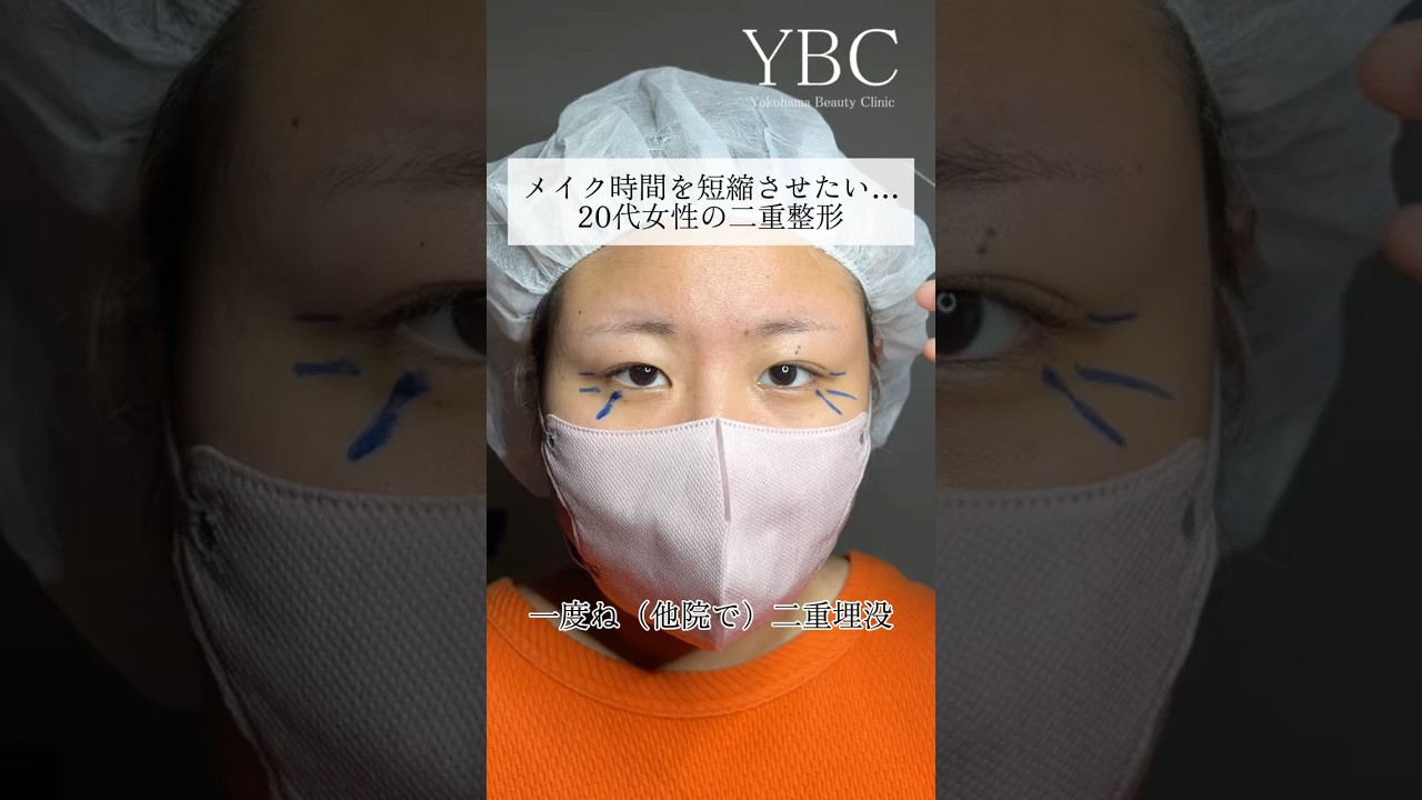 メイク時間を短縮させたい20代女性の二重整形#ybc横浜美容外科 #二重整形