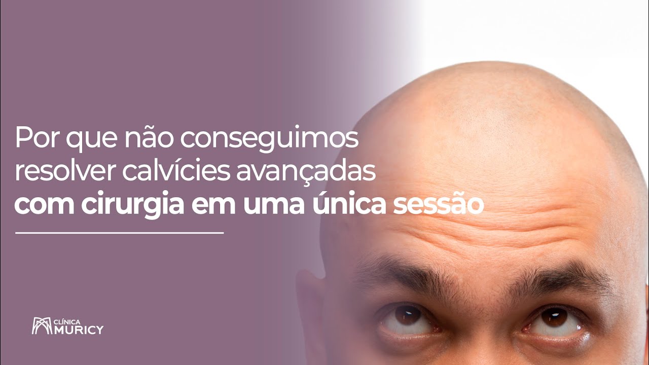 Por que não conseguimos resolver calvícies avançadas com cirurgia?