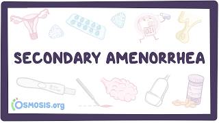 Secondary amenorrhea