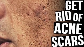 How To Get Rid Of Acne Scars | The BEST Methods!