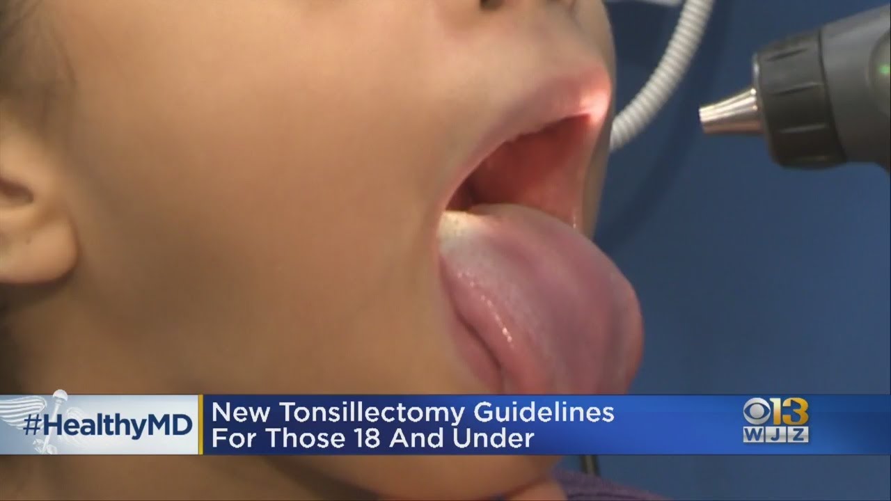 Healthwatch: New Tonsillectomy Guidelines For Those Under 18