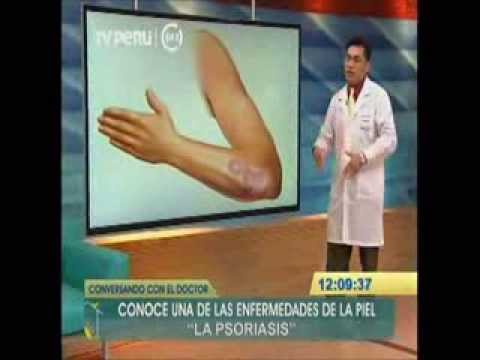 Las papillas útil a la psoriasis La psoriasis de la historia sobre el tratamiento