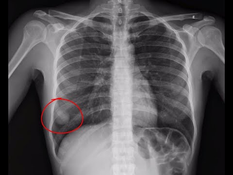 Raio-x de tórax no estadiamento dos cânceres ginecológicos