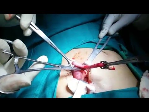 Ang mga resulta ng pagbaba ng timbang sa isang hiwalay na feed para sa isang buwan Ang ideal na kasangkapan para sa pagbaba ng timbang contraindications