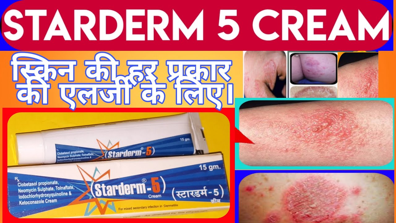 Starderm Cream Uses Dose Side Effects Full Review Hindi | Allergy Ki Best Cream