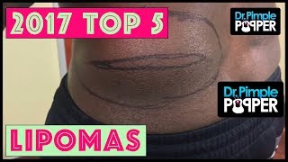 Dr Pimple Popper's Top 5 Lipoma POPS for 2017