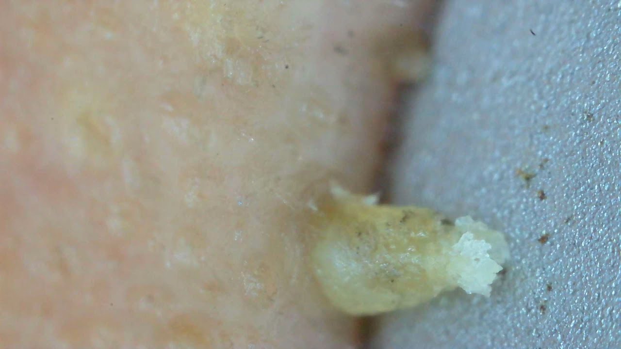 0329 keratin plug removal nose