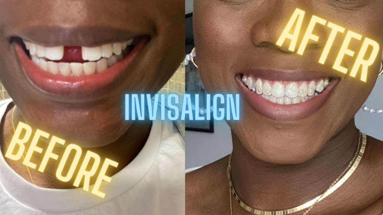 HOW TO CLOSE THE GAP IN YOUR TEETH - INVISALIGN BEFORE AND AFTER REVIEW