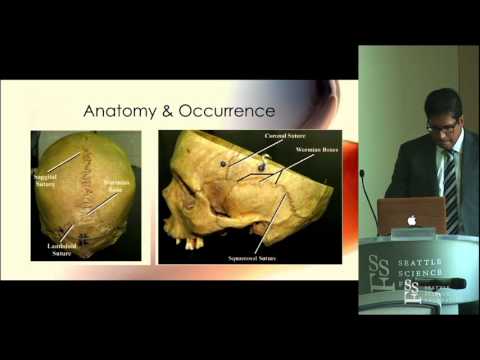 Anterior Fontanelle Wormian Bone - Jaspreet Johal, MD