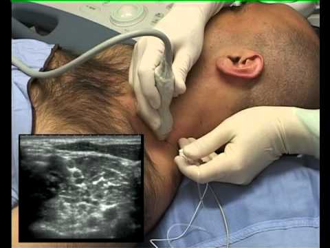 Interscalene Block (ultrasound guided - in plane)