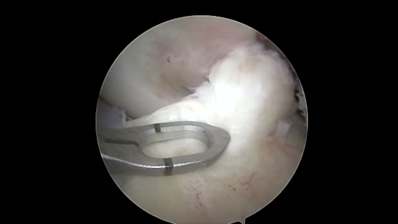 Dr. Garcia’s 2023 technique for ACL repair with internal brace