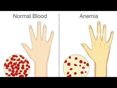 Introduction and Overview of Iron deficiency Anaemia