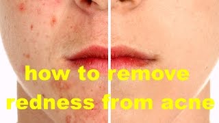 How to Remove Redness From Acne Scars Overnight | Get Rid Of Acne With Home Remedies