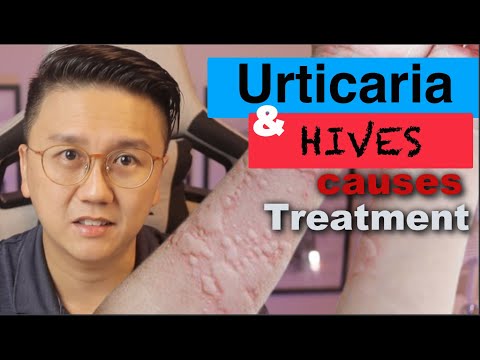 URTICARIA & HIVES - Causes and Treatment of Itchy Skin Rash