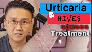 URTICARIA &amp; HIVES - Causes and Treatment of Itchy Skin Rash