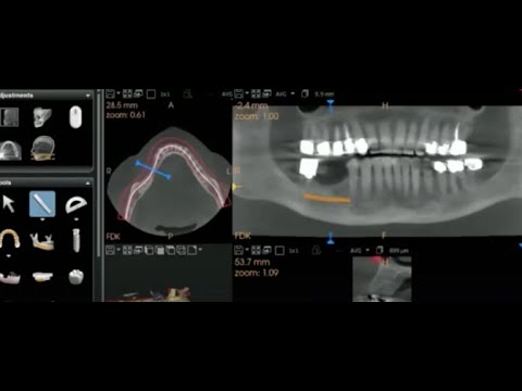 Advanced Alveolar Reconstruction with Ti Membrane by Dr. Tatch