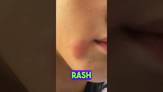 Facial Rash on Kid :Better After Swimming in Chlorinated Pool|What is it? #rash #facialskin #fungus