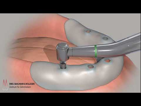 All on 4 Köln All on 6 Köln - Zahnimplantat & Zahnersatz