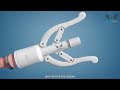 Circumcision Staplers From CLONMED Explained