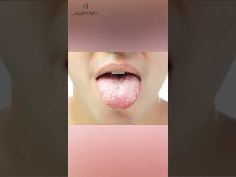 Dry mouth: xerostomia