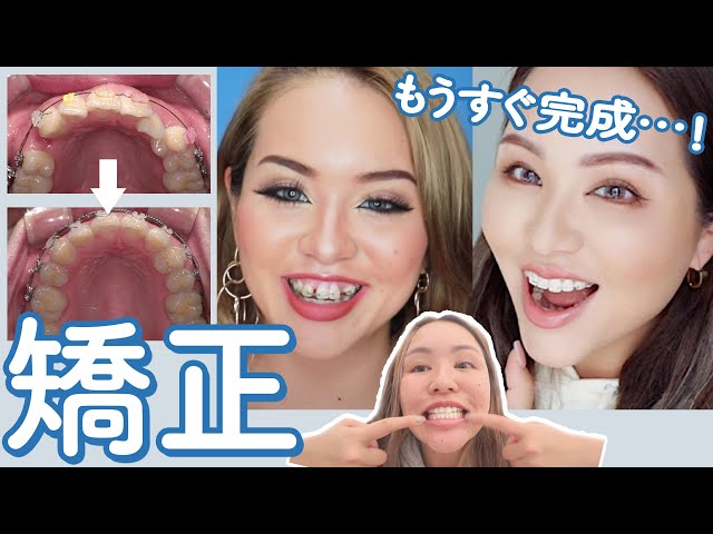 マリリンの歯列矯正の総額は 完成まで何年 Youyaak ユーヤーク 人気動画の最新まとめ情報をお届け