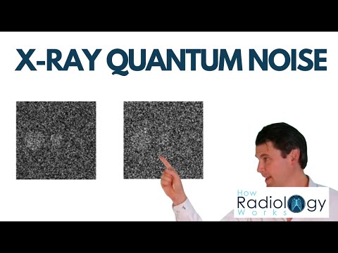X-Ray Noise (Quantum Noise)