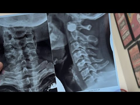 Cervical Pain Exercises video thumbnail