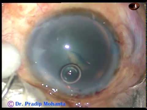 download lagu mp3 mp4 Utrata Forceps, download lagu Utrata Forceps gratis, unduh video klip Utrata Forceps