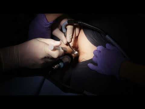 Asklerol Polidocanol Injection - Anti Hypertensive & Heart Disease Medicine Supplier