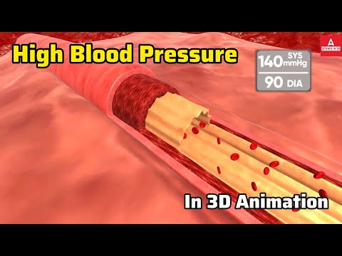 High Blood Pressure Explained in 3D | Understanding Hypertension