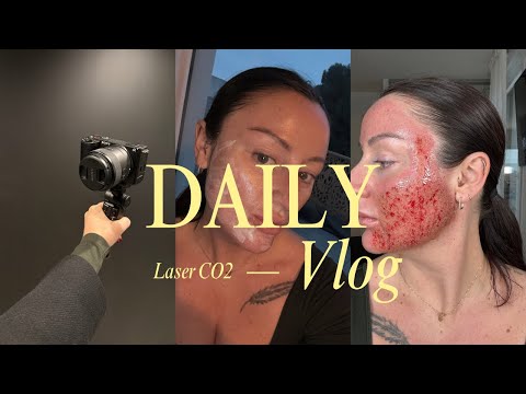 VLOG - Laser Ultrapulse alpha