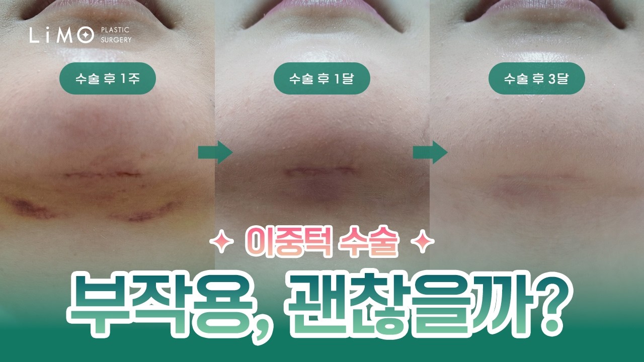 리모성형외과 유튜브 영상