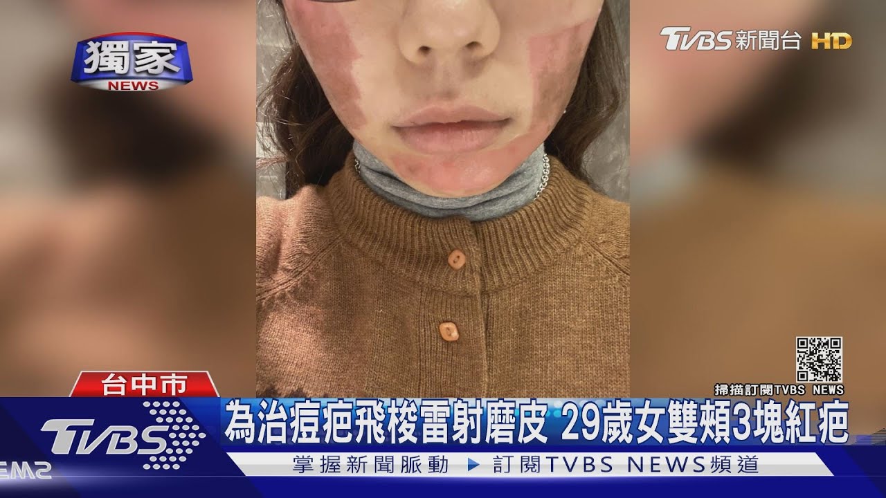 為治痘疤飛梭雷射磨皮 29歲女雙頰3塊紅疤