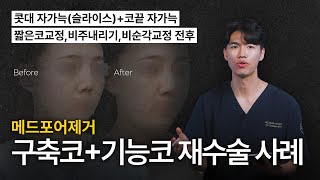 메드포어제거 구축코+기능코 재수술 사례 [늑떼선생김현주의 수술사례 및 케이스리뷰]