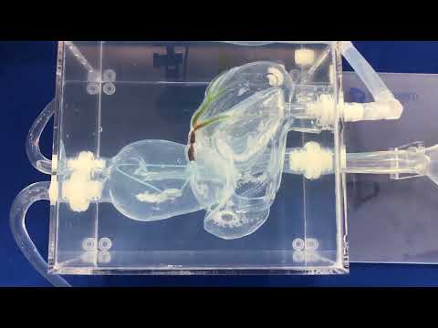Transcatheter Aortic Valve Implantation (TAVI) | Streamlined transfemoral TAVI procedure