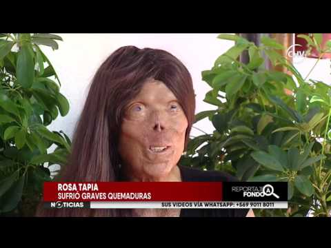 Mujer quemada lucha para reconstruir su rostro - Reportaje completo