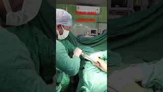 Tibia nail removal | Tibia bone fracture| Leg bone rod removal | Bone rod removal #bone #fracture