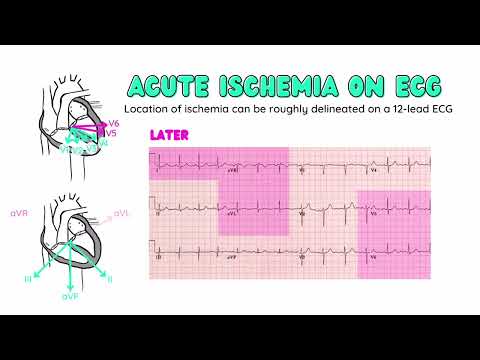 Intro to Ischemic Heart Disease - Coronary Artery Disease, Atherosclerosis, ECG Findings, Statins