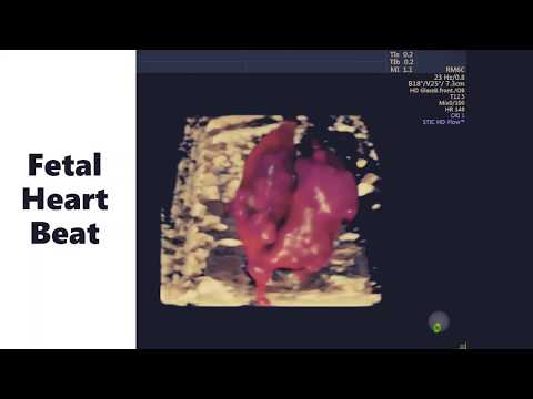 Fetal heart, STIC HD-Flow