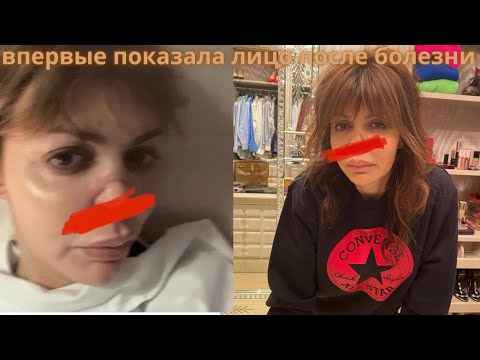 Алиса Аршавина-(Казьмина) впервые показала вблизи изуродованное болезнью лицо